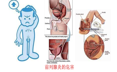 久坐易患前列腺炎 影响生育能力